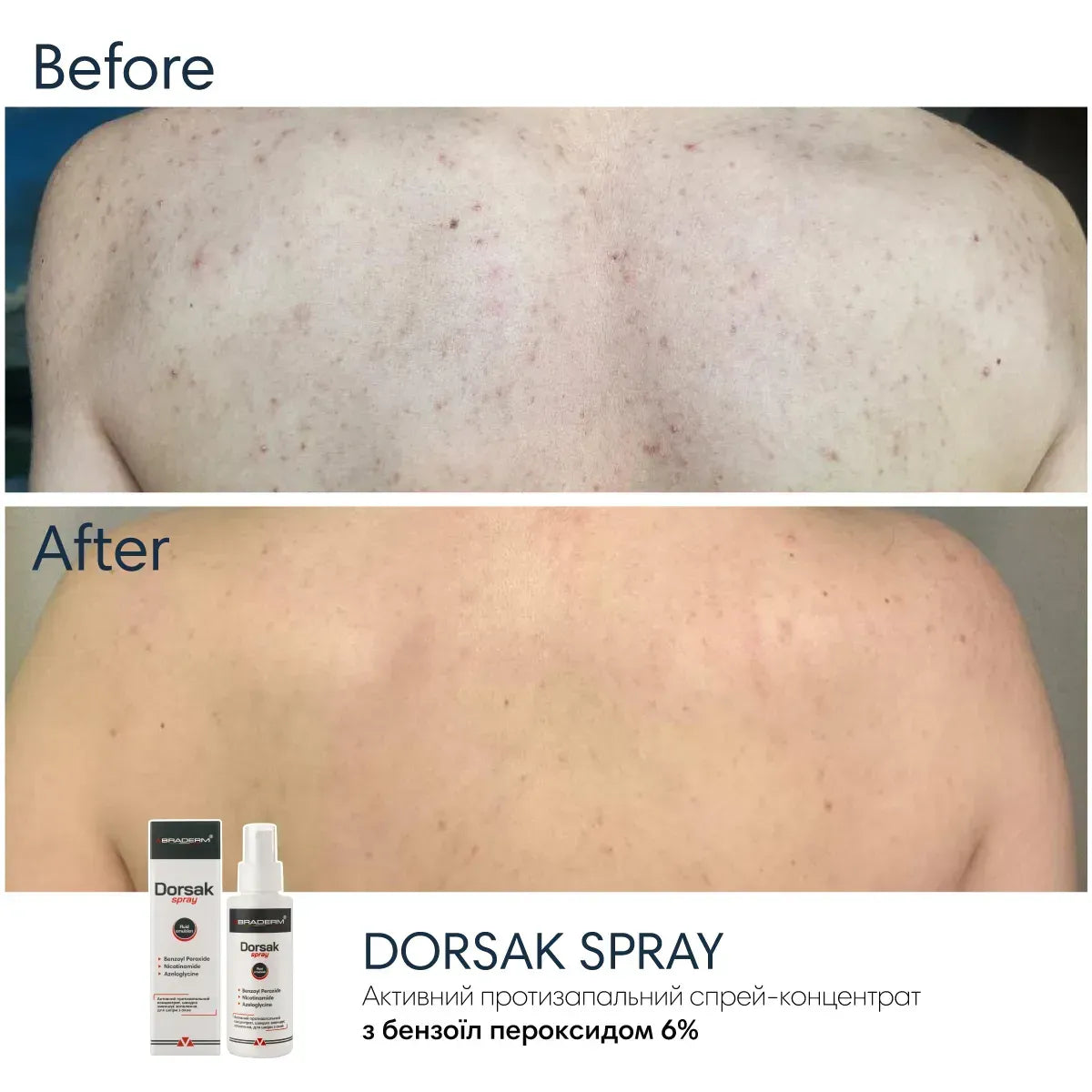 Braderm Dorsak Spray