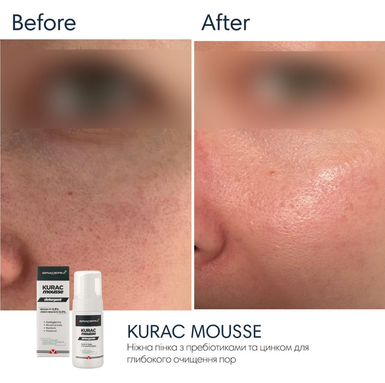 Braderm Kurac Cleansing Mousse