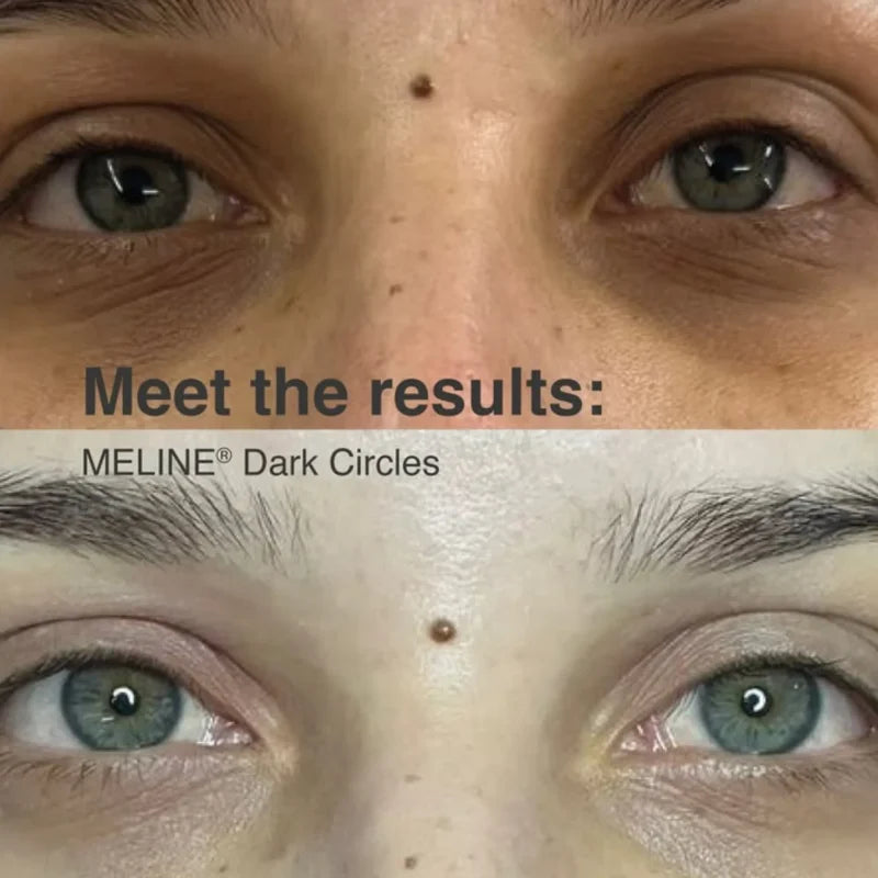 Me Line Dark Circles
