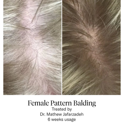 Calecim Advanced Hair System