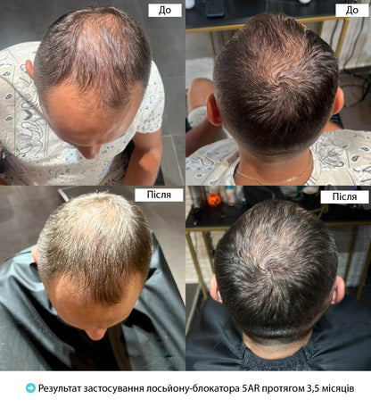 Full Force Hair Lotion 5AR Restrain Intensive Growth